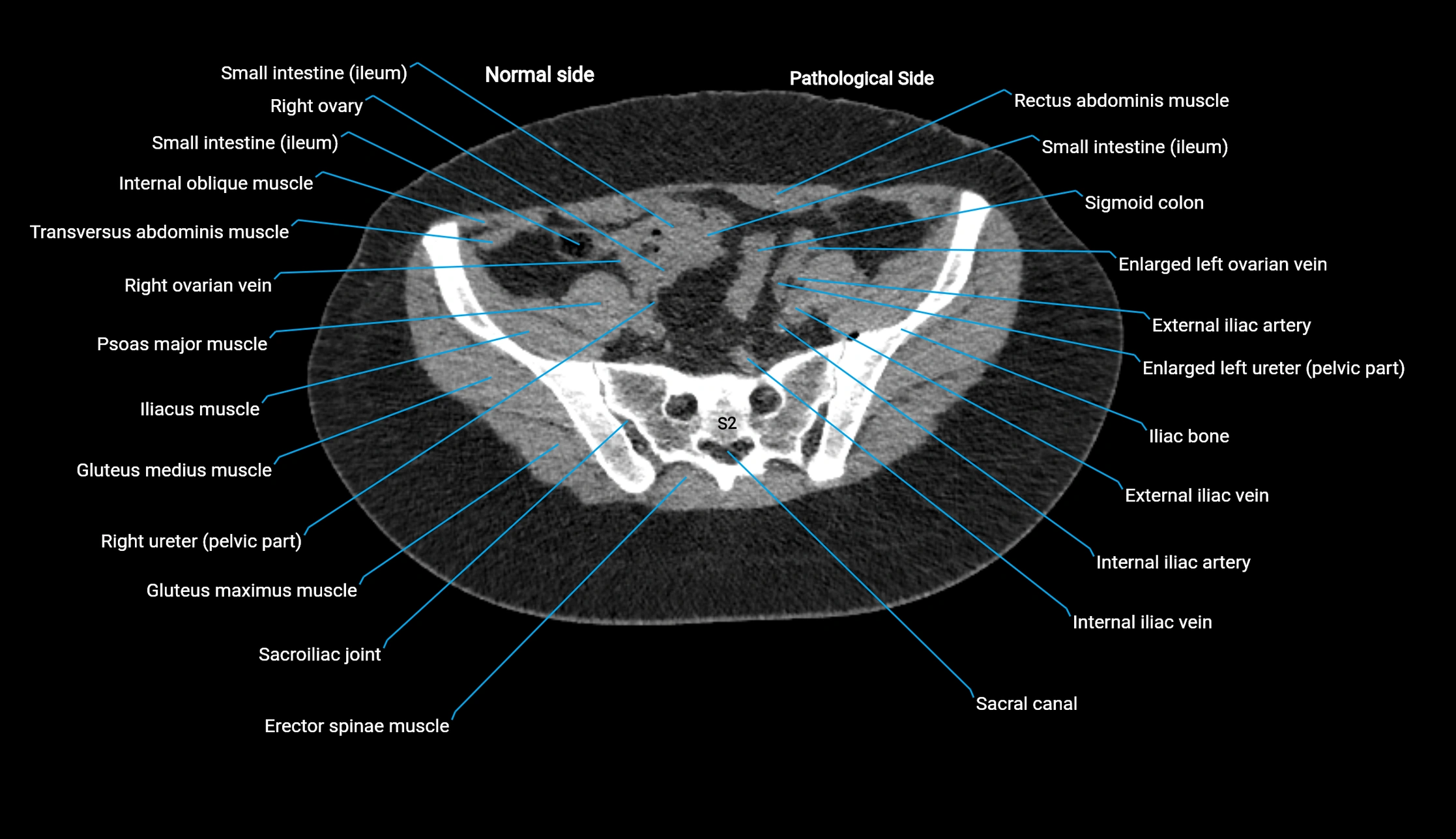 CT KUB axial cross sectional anatomy  radiology image -img-00201-00122.webp